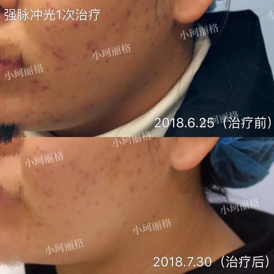 M22光子嫩膚價格探尋，美麗之旅的心靈安寧之路