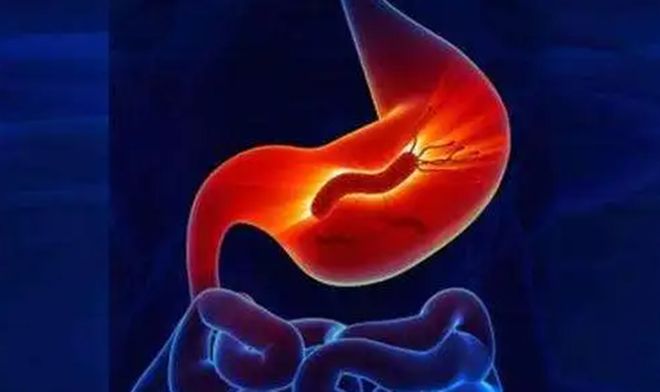 幽門螺桿菌新型治療方法概述,幽門螺桿菌新型治療方法概述