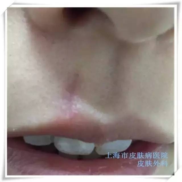 科技之光引領去痣新法，照亮美麗之路新篇章