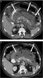 急性胰腺炎最新分型揭秘，一日之奇妙與疾病分型探索